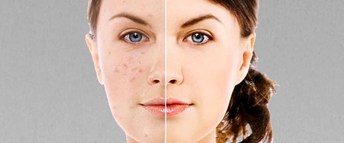 article about why argan oil is ok for acne skin girls face closeup with acne